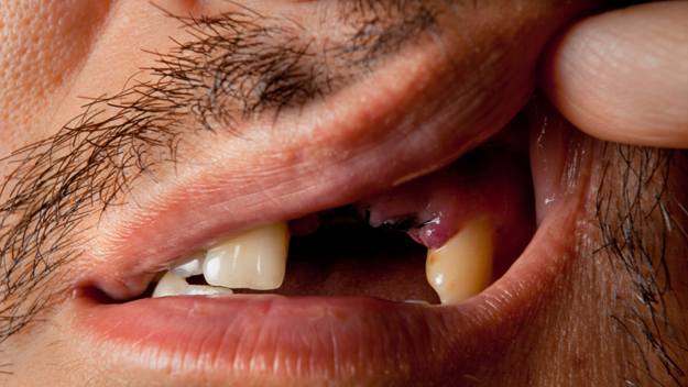 Losing Your Teeth Man's missing teeth