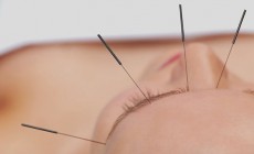 Acupuncture Anyone