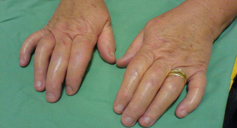 psoriatic arthritis