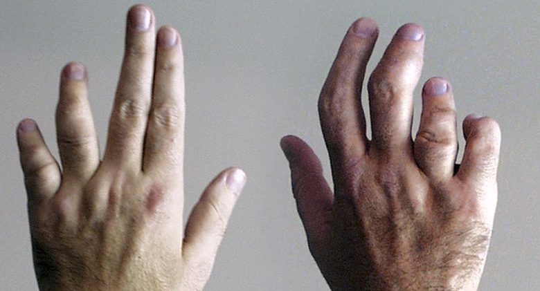 psoriatic_arthritis_hands
